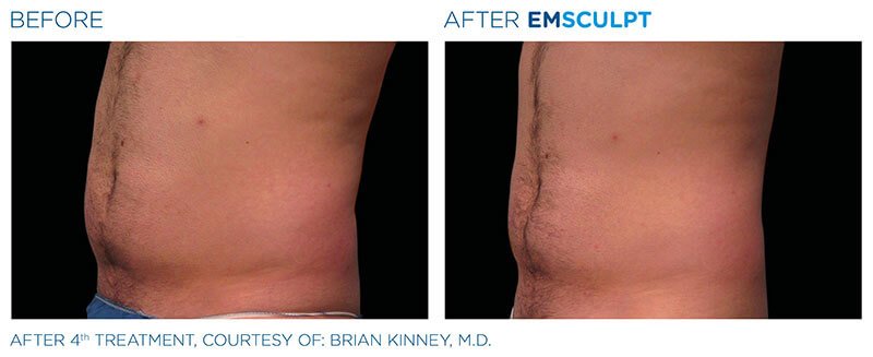 EMSCULPT® Before and After Photos