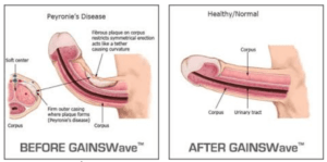 GAINSWave® Therapy1